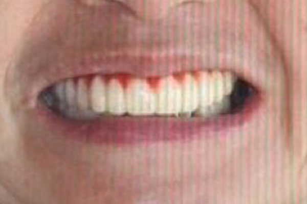 症例